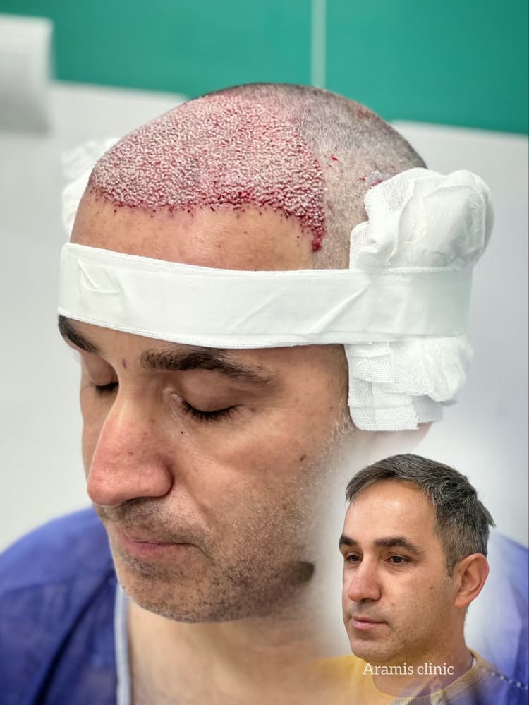 تصویر 2 - نمونه کار کاشت مو 1