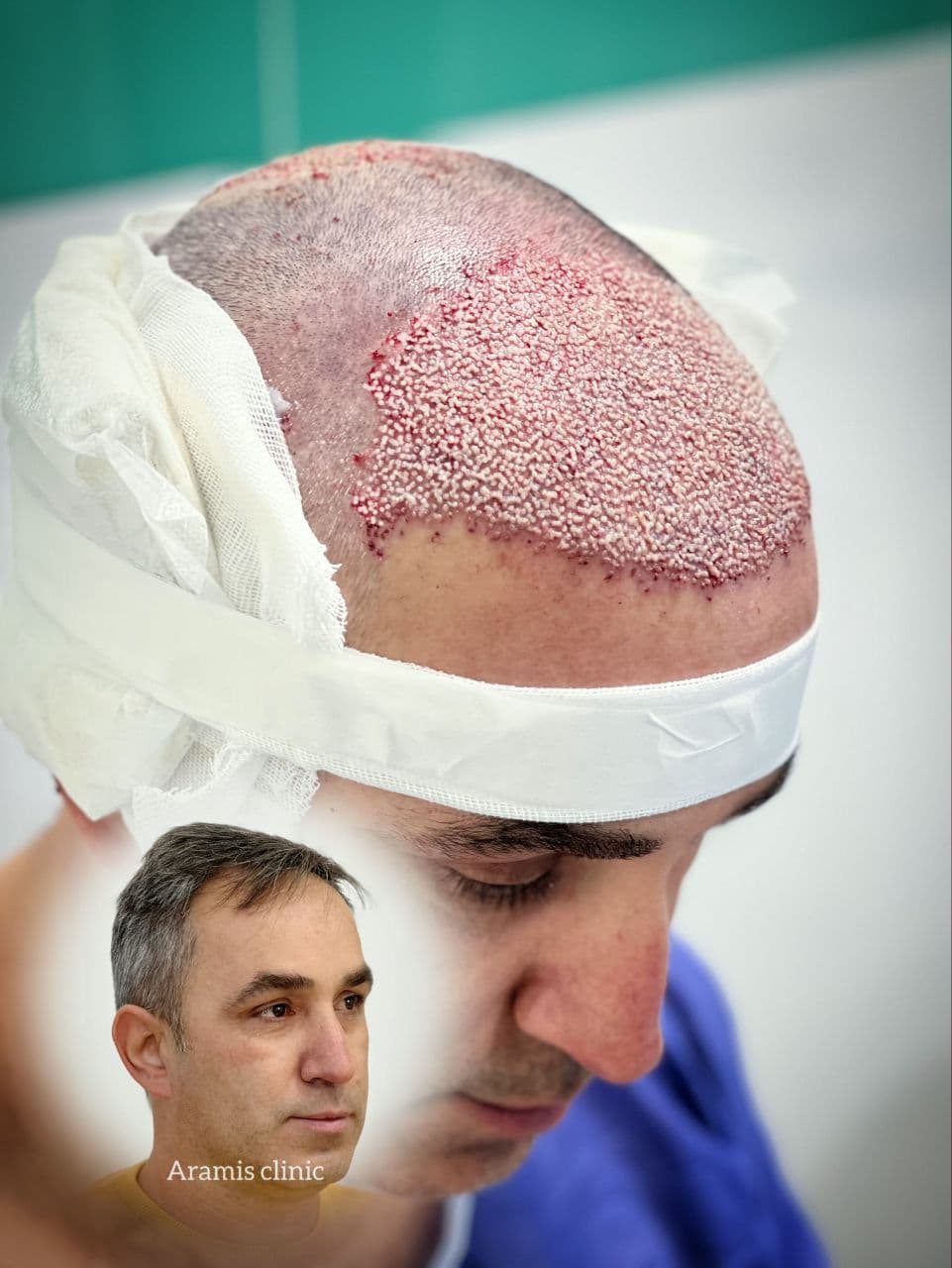 نمونه کار کاشت مو 1