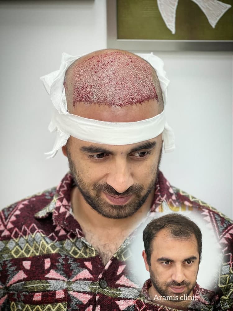 تصویر 2 - نمونه کار کاشت مو 3