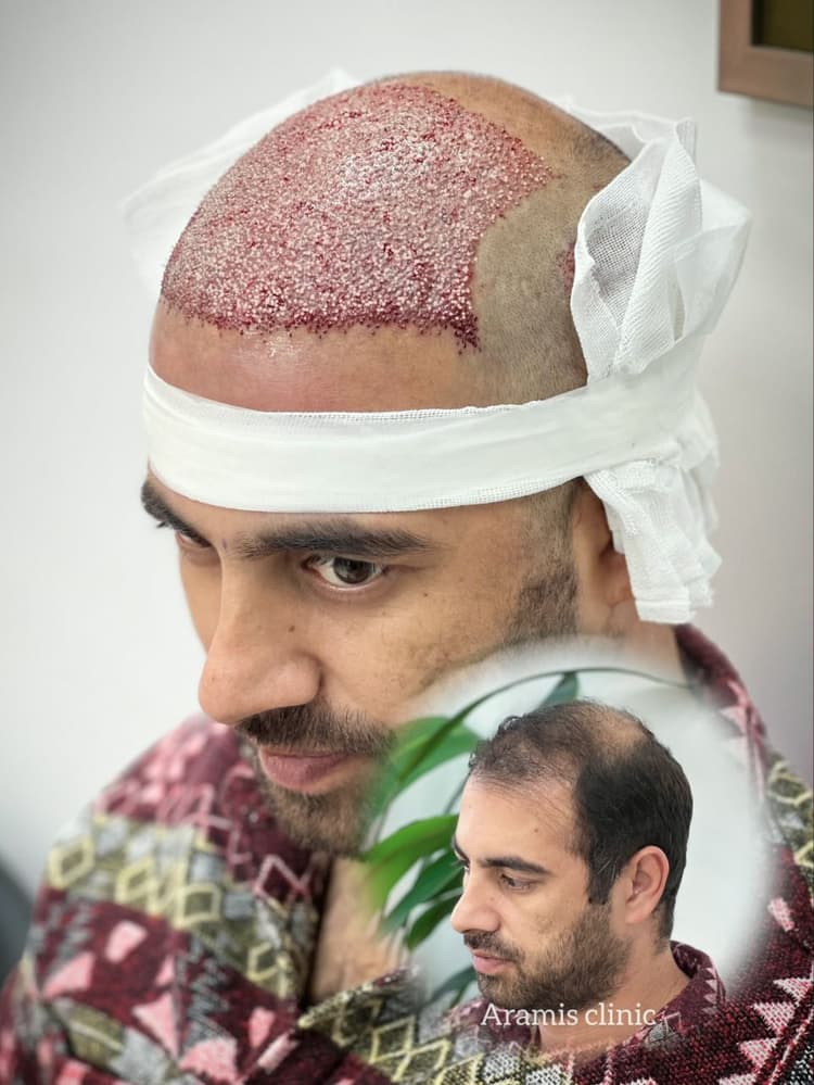 تصویر 1 - نمونه کار کاشت مو 3