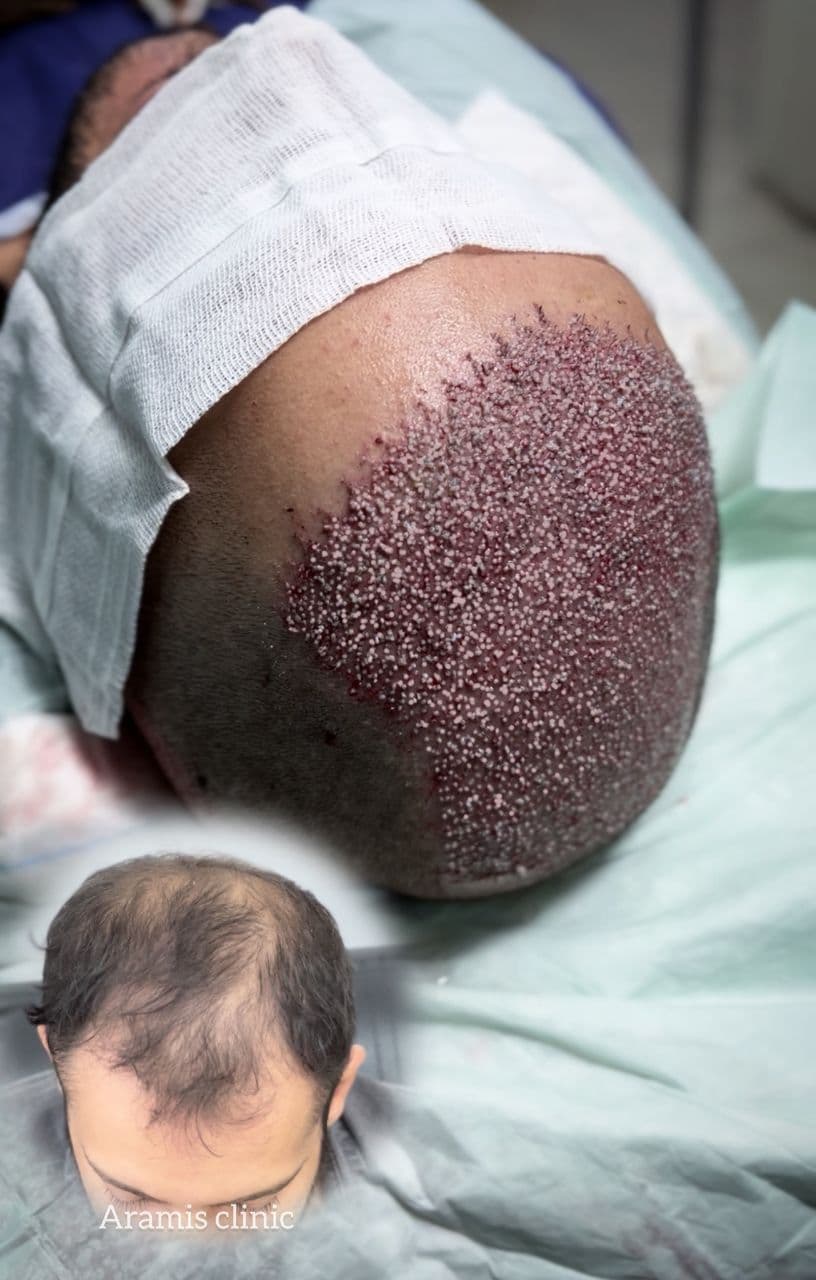 نمونه کار کاشت مو 4